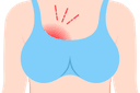 Natural Lactational Mastitis Treatements During Breastfeeding