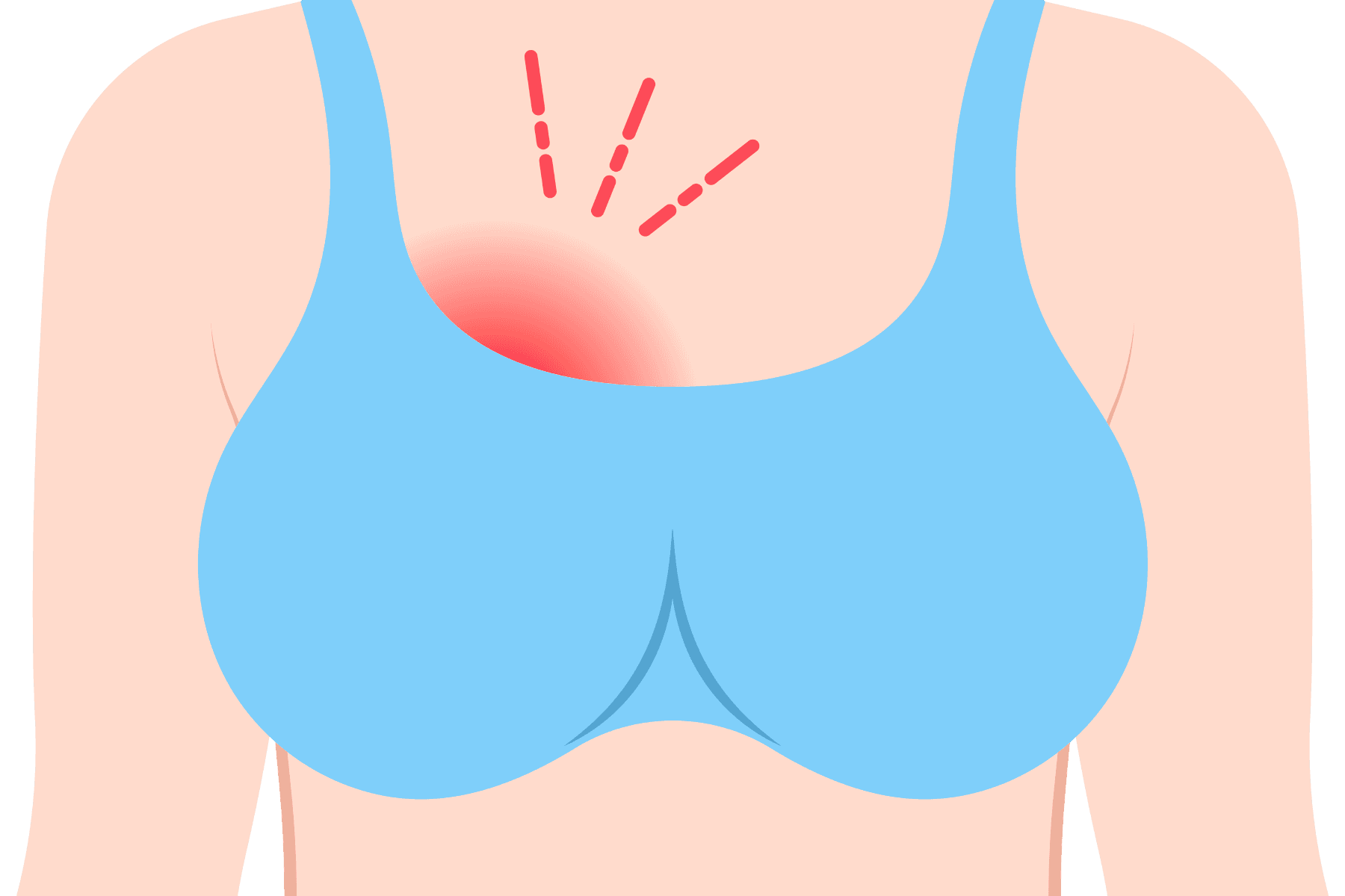 Featured image for Natural Lactational Mastitis Treatements During Breastfeeding